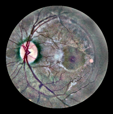 Fundus photograph showing retinal surface with blood vessels, optic disc, and macula