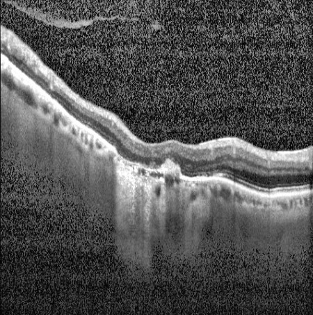 OCT cross-sectional scan showing retinal layers and foveal structure